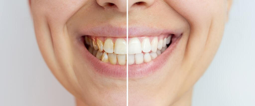 Do Natural Teeth Whitening Remedies Really Work?